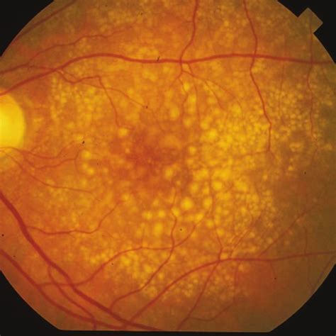 The left figure shows SD-OCT image of an eye with drusen. The drusen... | Download Scientific ...