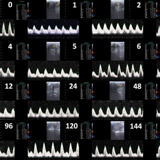 Representative ultrasound sonogram of the pampiniform plexus in ram... | Download Scientific Diagram