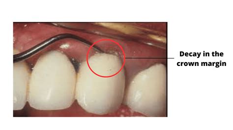 Revealing cavities under a crown: What you need to know