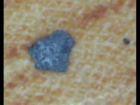 Morgellons Under a Microscope - YouTube