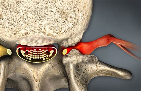 Foraminal Narrowing - Causes, Symptoms & Treatment | Bonati