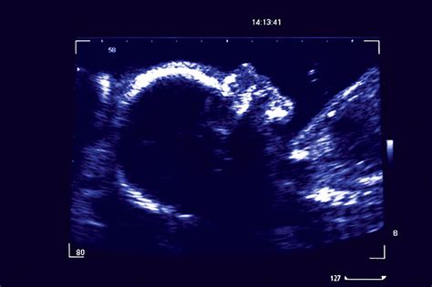 26 Weeks Pregnant Fetus, Symptoms, Ultrasound: What to Expect