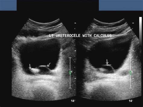 WK 5 RENAL URETEROCELE WITH STONE HOW COULD WE GET THIS STONE TO SHADOW ...