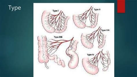 case study of jejunal atresia | PPT