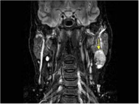 Head and Neck | 4.3 Salivary glands : Case 4.3.4 Warthin's tumors | Ultrasound Cases