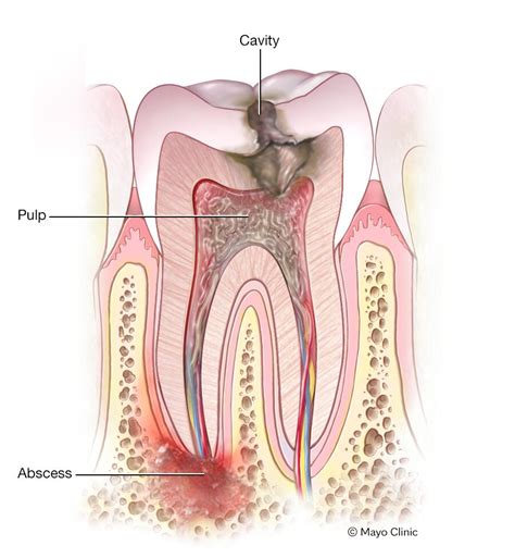 Dental Abscess - Stages, Causes, Symptoms & Treatments - An Tâm