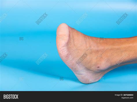 Amputation All Toes Image & Photo (Free Trial) | Bigstock