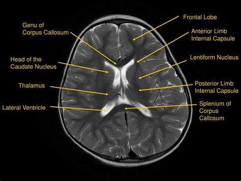 PPT - MRI of Brain/Head and Neck PowerPoint Presentation, free download ...