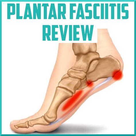 Plantar Fasciitis Review - Sports Medicine Review