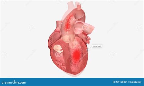 Cardiomyopathy is a Disease of the Heart Muscle that Causes the Stock ...