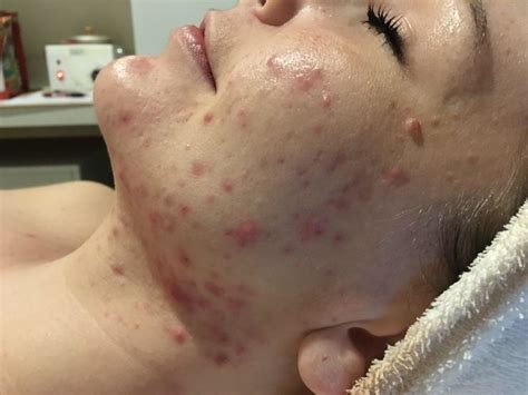 ACNE: A Common Skin Problem | Skin problems, Skin, Acne