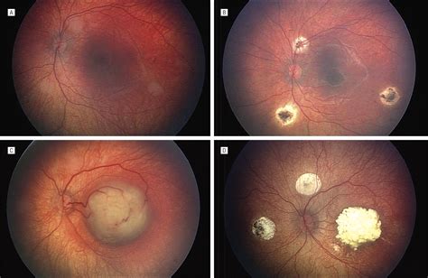 Retinoblastoma Regression Patterns Following Chemoreduction and ...