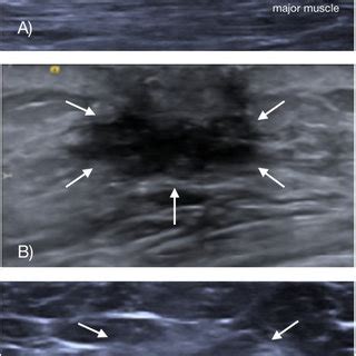 Ultrasound images of the retroareolar region. A) Normal male breast ...