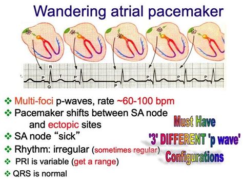 Pin by dr mooni on cardiology | P wave, Cardiology, Rhythms