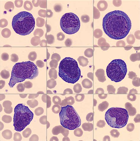 Atypical Lymphocytes - Atypical Or Reactive Lymphocytes Are Lymphocytes That As A Re Stock Photo ...