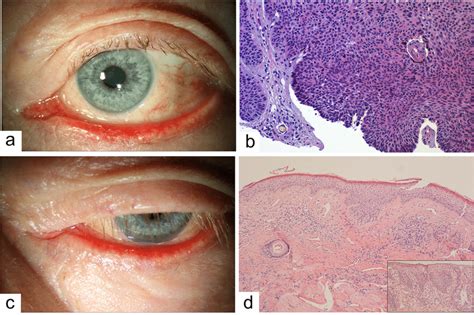 Lower eyelid basal cell carcinoma (BCC) treated with sonidegib. a A ...