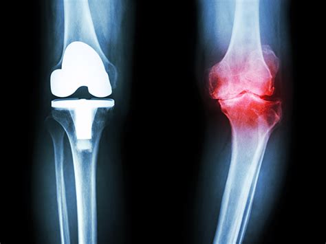 Treatment Options for Degenerative Joint Disease