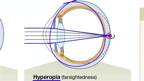 Light Refraction and Focused Vision in the Eye - YouTube