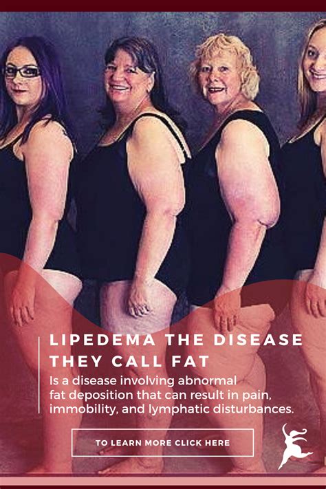 Pin on Lipedema The Disease They Call Fat