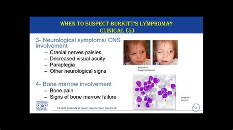 Diagnosis and Referral of Burkitt’s Lymphoma – 3 February 2023 - YouTube