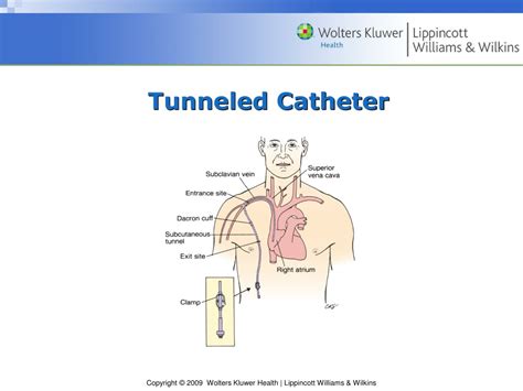 24 core tunnel catheter - trekbatman