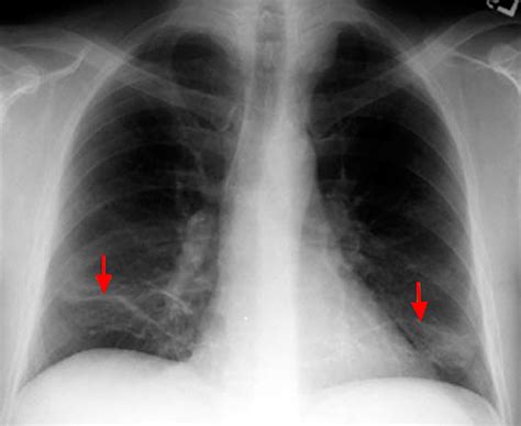 Atelectasis Care Plan for Nursing Students - Straight A Nursing