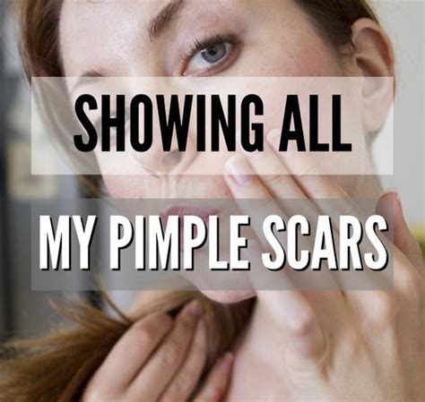 Showing All My Pimple Scars