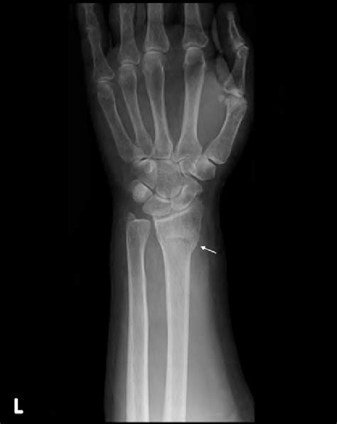 An x-ray showing left distal radius fracture of the patient (arrow ...