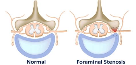 What Causes Foraminal Narrowing? - Foraminal Stenosis Causes