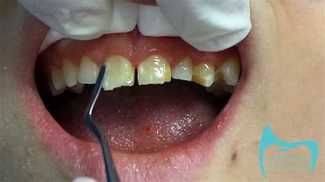 Composite Veneers !!! Full procedure - YouTube