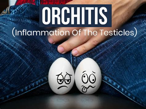 Orchitis (Inflammation Of The Testicles): Causes, Symptoms, Risk ...