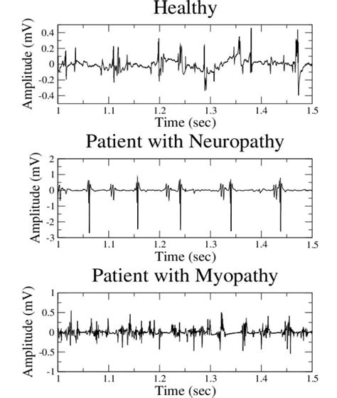 Emg Test Results