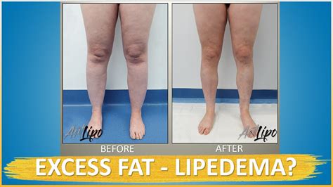 Lipo 360° Legs | Immediate Results | Lipedema Surgery | Cankles & Knees | Expert Dr. Thomas Su ...