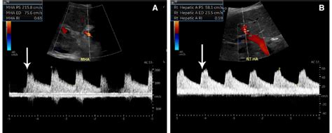 Hepatic Artery Ultrasound