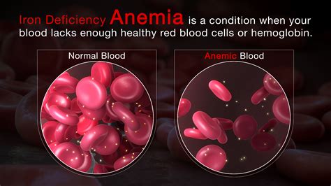 Who Is at Higher Risk of Iron-deficiency Anemia? - Nutricomplete