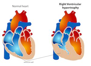 Cor Pulmonale: Definition, Symptoms & Treatment | Study.com