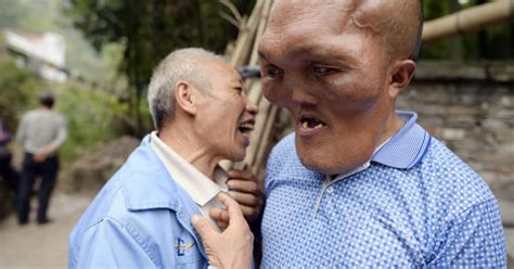 Surgery hopes for 'alien man' with deformed face - Daily Star