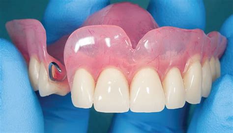 Care Strategies for Removable Dental Prostheses - Decisions in Dentistry