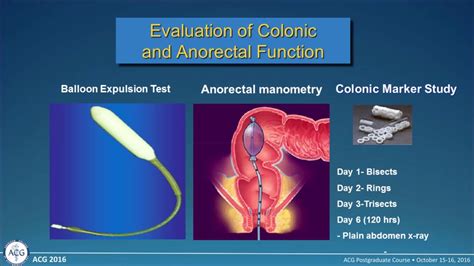 What Is Pelvic Floor Dyssynergia | Viewfloor.co