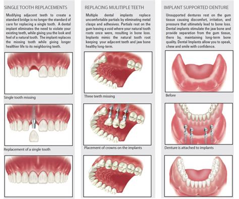 Types of Dental Implant |Dental Clinic in Madurai | Agaram Dental Clinic Dentist