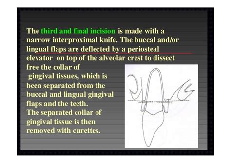 Modified widman flap