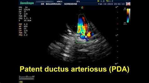 Patent Ductus Arteriosus Echocardiography