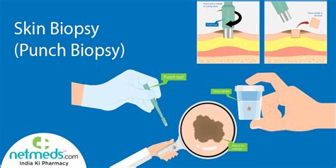 Skin Biopsy: Procedure, Risks And Results