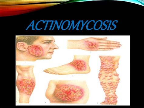 Actinomycosis Information