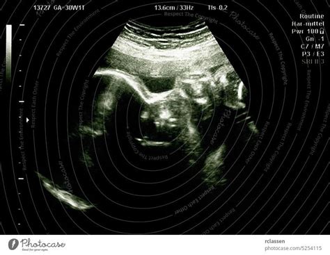 Ultrasound of baby in a mothers womb - a Royalty Free Stock Photo from Photocase