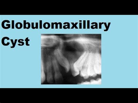 Globulomaxillary Cyst - YouTube