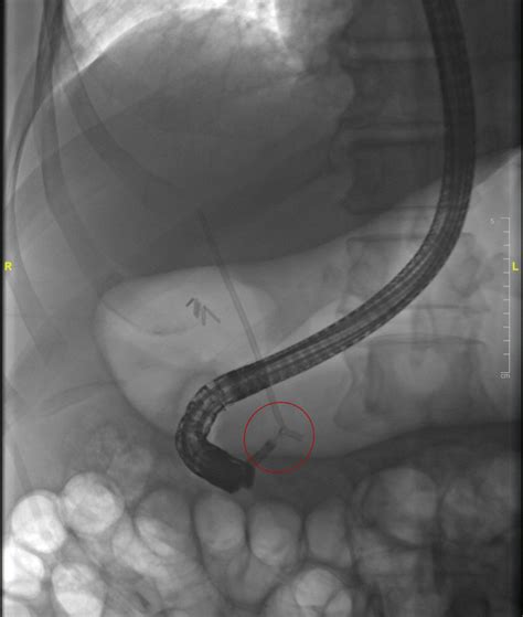 Removal of proximally migrated biliary stents by using single-operator cholangioscopy - VideoGIE