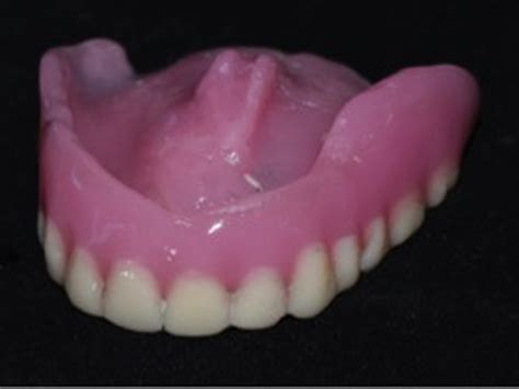 Intra Oral Photograph Showing Maxillary And Mandibular Dentures In | My ...