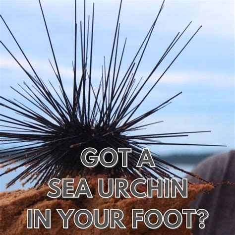 Sea Urchin in Foot Removal & Treatments! in 2021 | Sea, Sea urchin, Urchin