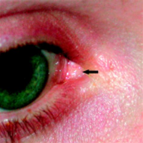 Steatocystoma simplex of the caruncle | British Journal of Ophthalmology